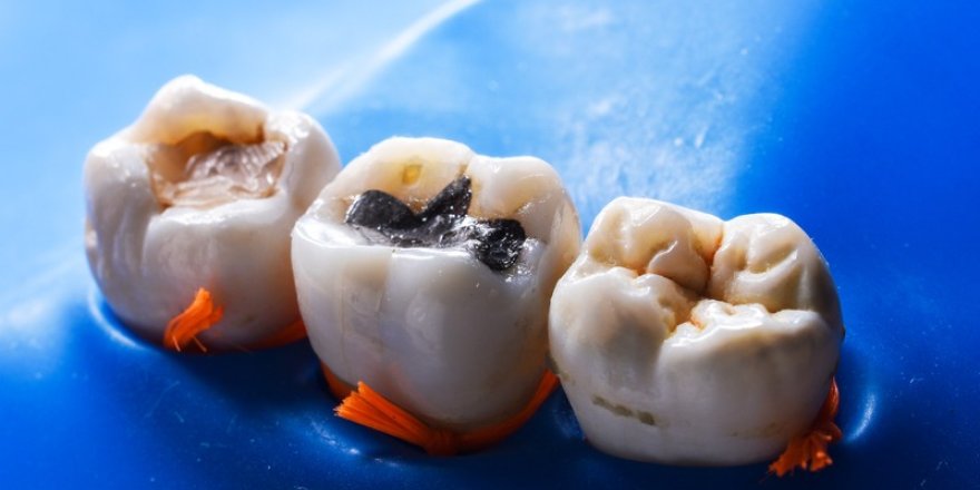 Hangi Diş Dolgusu Türü Sizin İçin Uygun?