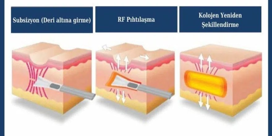 İz Kalmadan Sivilce Tedavisi Mümkün mü? Ne Zaman Müdahale Edilmeli?