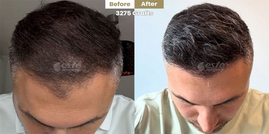 Este Surgery – Premium fue with Advanced fue technique