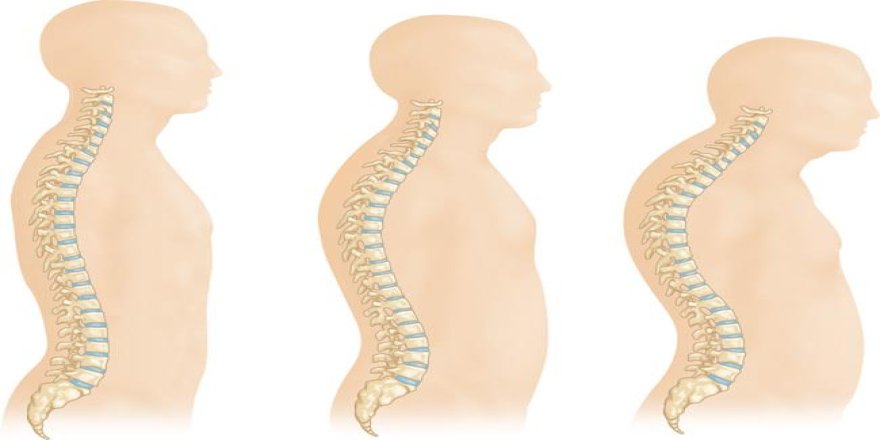 Osteoporoz ve Omurga Kırıkları: Yaşlılarda Sessiz Tehlike