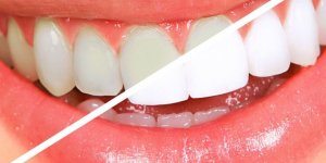 Doğal Diş Beyazlatma
