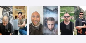 Türkiye Saç Ekimi (Hair Transplant Turkey) Nasıl Yaptırılır?